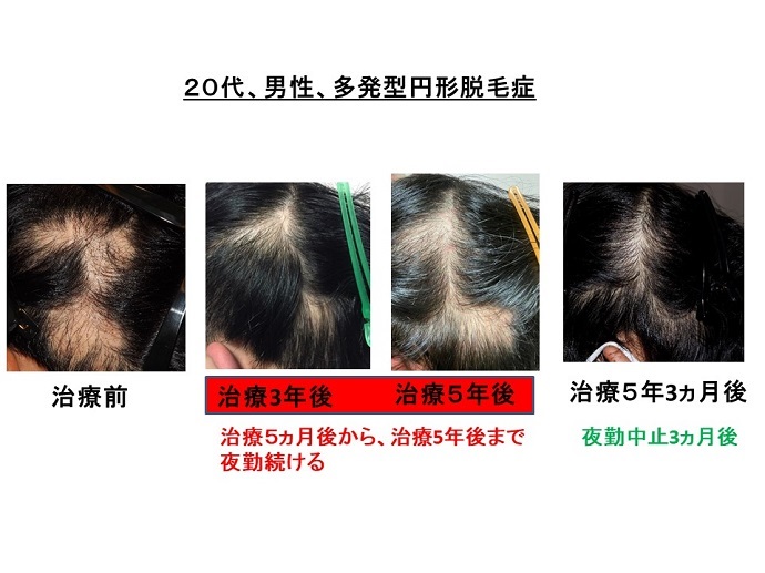 円形脱毛症　病院